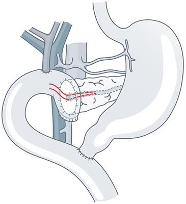 Preoperative risk assessment for postoperative pancreatic fistula (POPF): Image-based calculation of duct-to-parenchyma (D/P) ratio and an Alignment of Duct and Mucosa (ADAM) anastomosis may lead to a low POPF rate—results from 386 patients